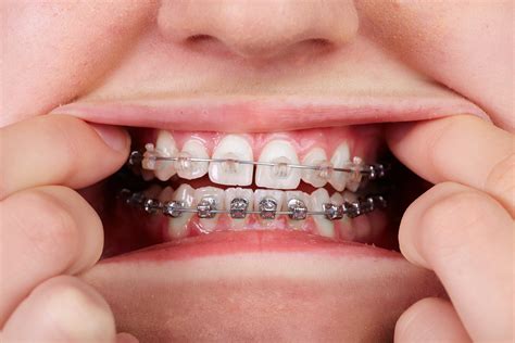 dental metal brackets|clear braces versus metal.